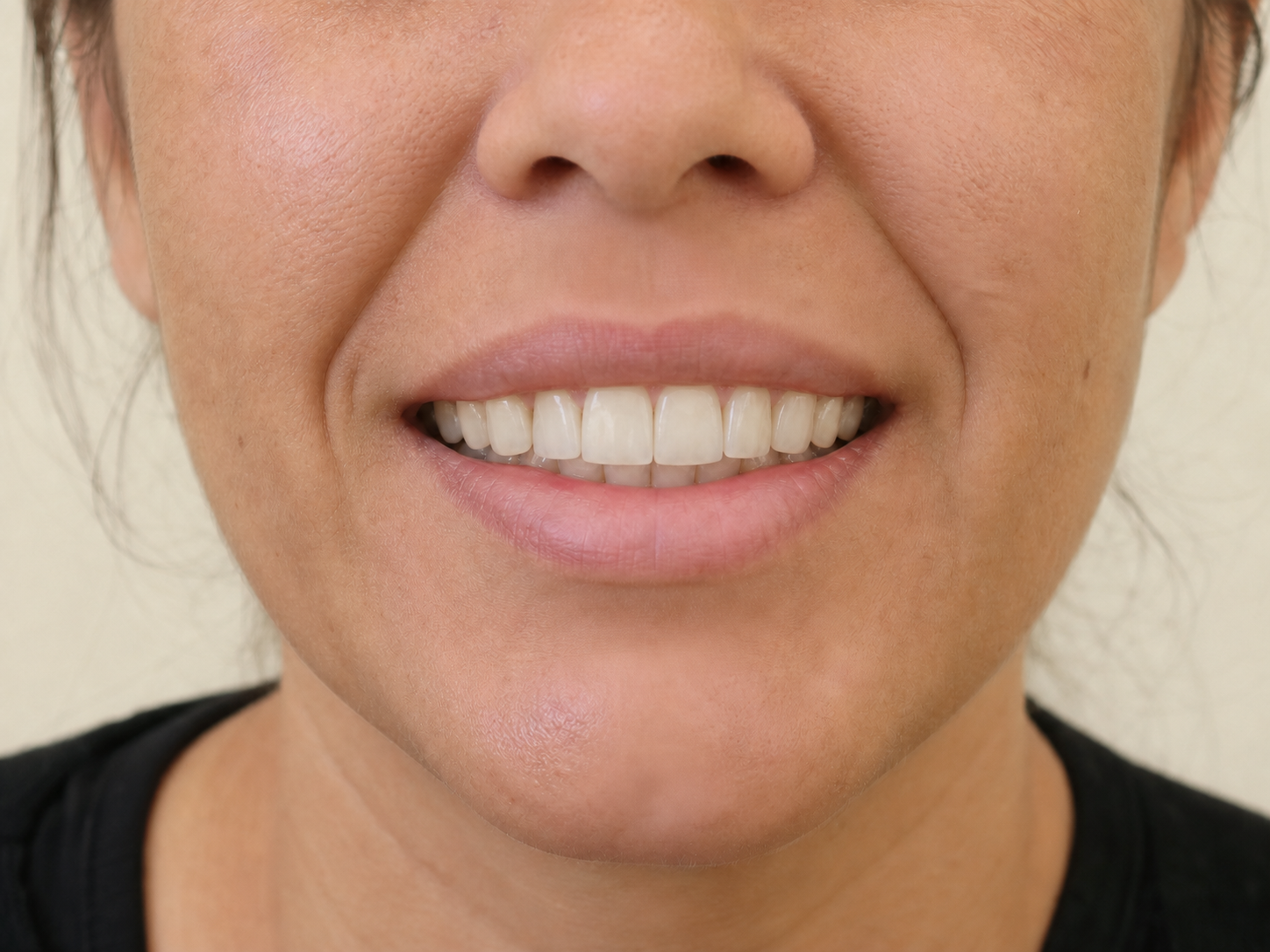 Sorriso depois do refinamento estético