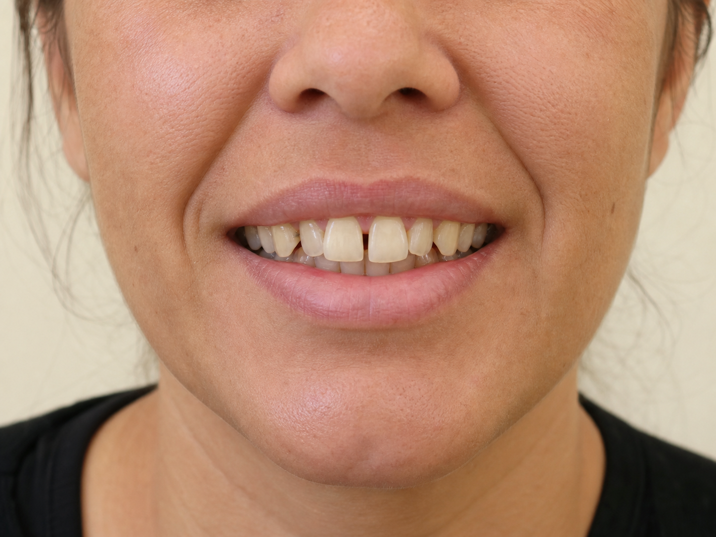Sorriso antes do refinamento estético